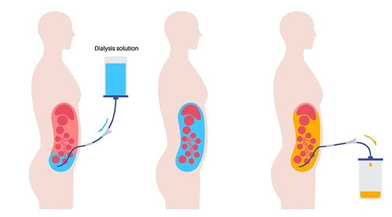 علائم مسمومیت با محلول آلوده دیالیز صفاقی چه بود؟/ گفتوگو با خانواده یکی از بیماران/ ۱۰ نفر قربانی/ درخواست محاکمه برای عاملان