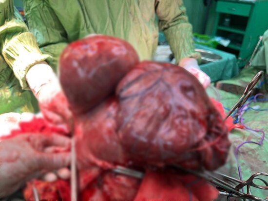 خارج کردن تومور ۱۱ کیلویی از شکم بیمار در استان فارس/ عکس