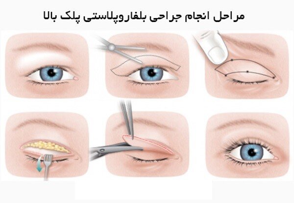 درباره عمل بلفاروپلاستی چه میدانید؟