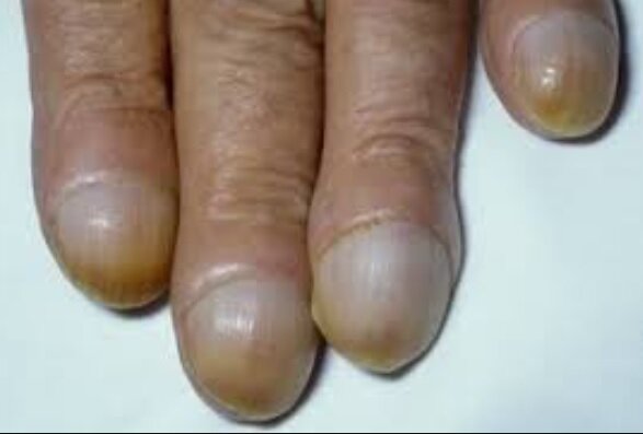 ظاهر ناخنها خبر از چه بیماریهایی میدهند؟/ این ۷ نشانه را جدی بگیرید