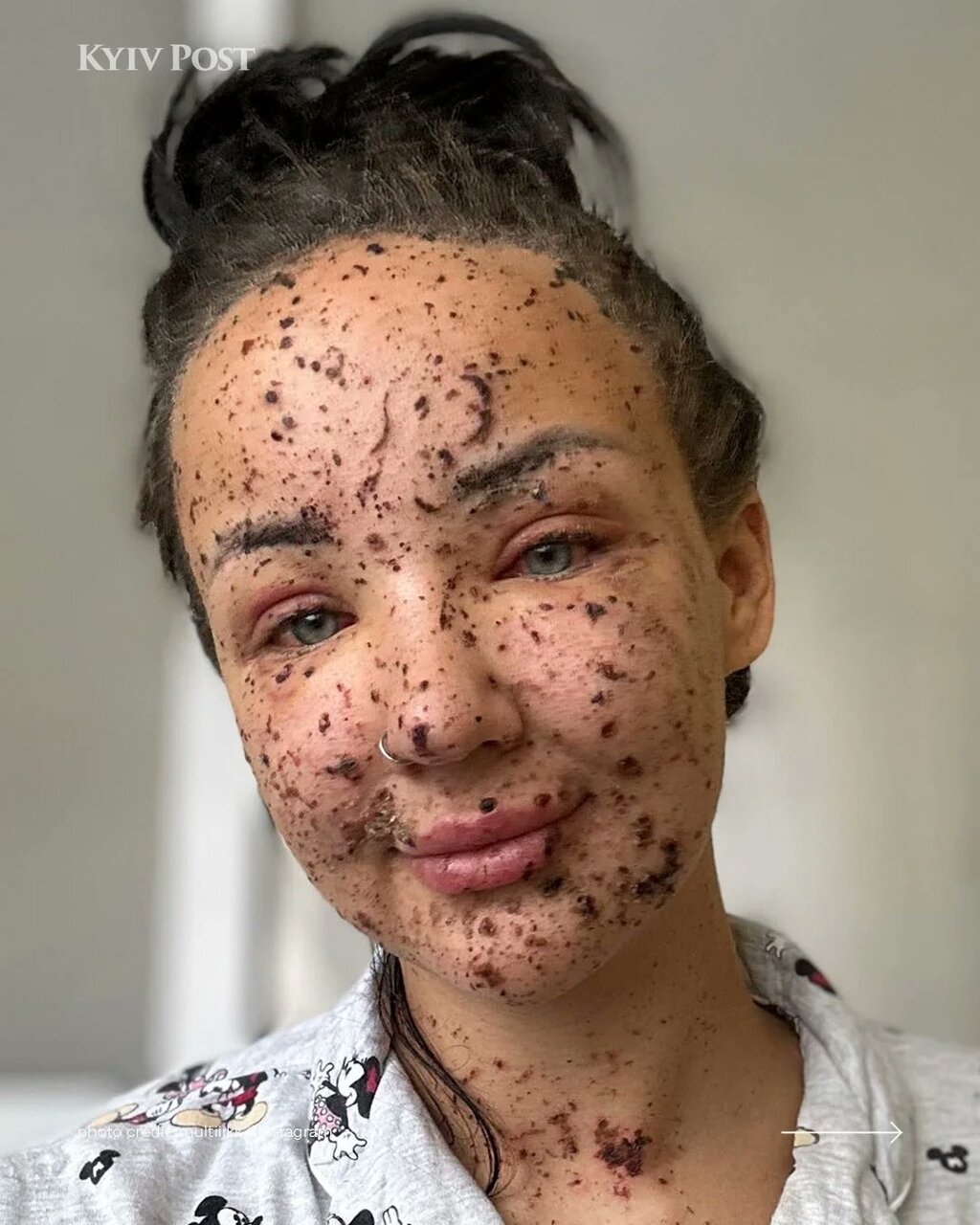 عکس | وضعیت صورت اپراتور زن یگان پهپاد ارتش اوکراین بعد از جراحت سنگین در خط مقدم!