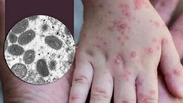 بیماری آبله میمونی تا کنون در استان کرمان گزارش نشده است بیماری آبله میمونی تا کنون در استان کرمان گزارش نشده است