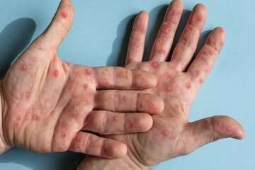 تایید دومین مورد آبله میمونی جهشیافته در خارج از آفریقا / زنگ خطر همهگیری؟ تایید دومین مورد آبله میمونی جهشیافته در خارج از آفریقا / زنگ خطر همهگیری؟