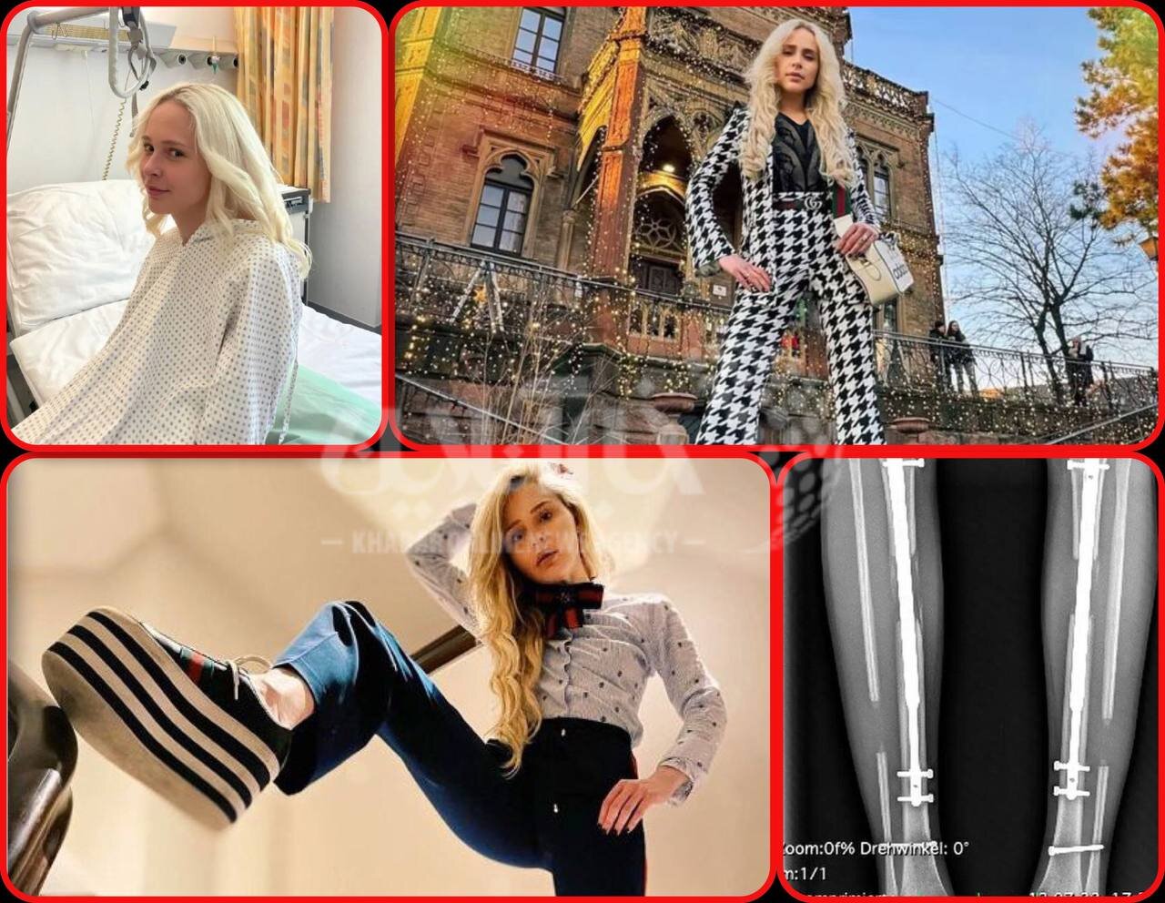 عکس | درخواست جنونآمیز خواستگار برای عاشقی؛ وقتی دختر جوان با خرج ۷۵۰ میلیون تومان، ۱۴ سانتیمتر قدش را افزایش داد!