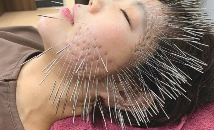 روش جدید استفاده از طب سوزنی در ژاپن/ بیمار شبیه جوجه تیغی میشود/ عکس