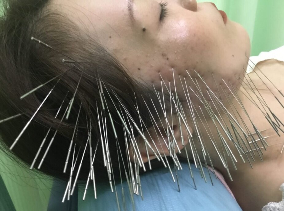 روش جدید استفاده از طب سوزنی در ژاپن/ بیمار شبیه جوجه تیغی میشود/ عکس
