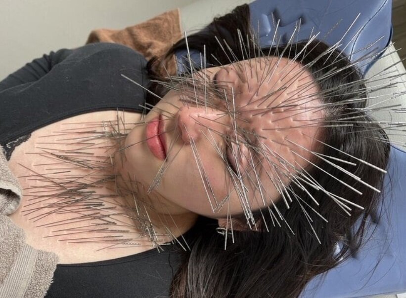 روش جدید استفاده از طب سوزنی در ژاپن/ بیمار شبیه جوجه تیغی میشود/ عکس