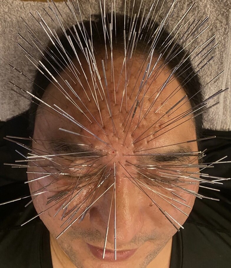 روش جدید استفاده از طب سوزنی در ژاپن/ بیمار شبیه جوجه تیغی میشود/ عکس