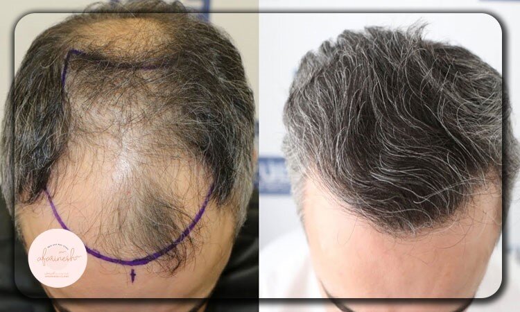 تغییر چهره با کاشت مو؛ از رویا تا واقعیت