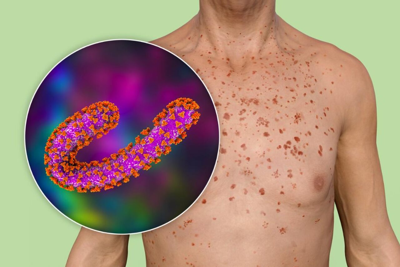 آژانسهای بهداشتی بینالمللی در حال آماده باش/ ویروس ماربورگ چیست؟