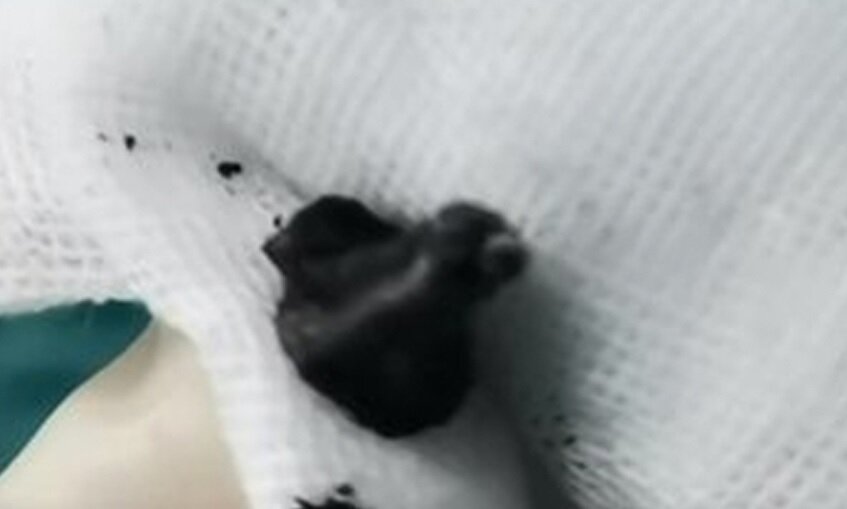 ماجرای پسر بچهای که مدام از بوی بد شکایت میکرد/ در بینی این پسر چه بود؟/ عکس