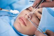 جراحی زیبایی بینی در پاییز و زمستان خطرناک است!/ توضیح یک متخصص