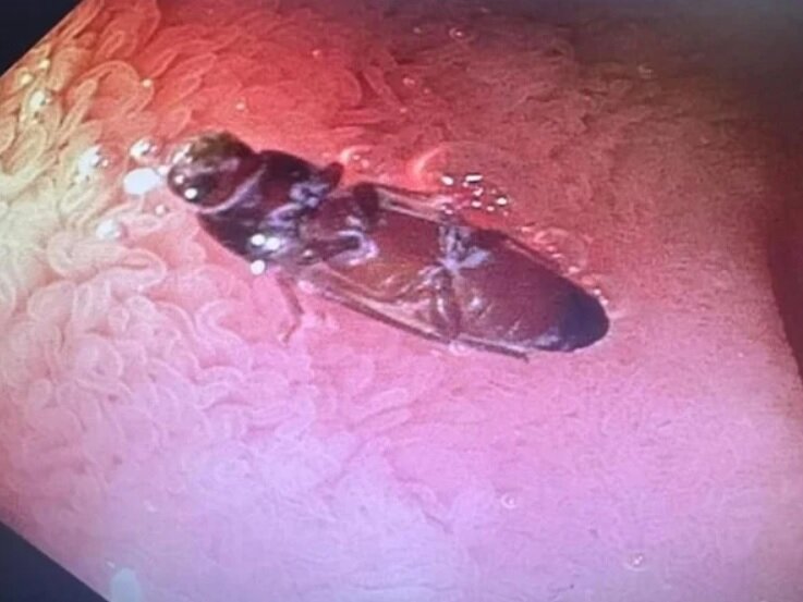 وجود سوسک زنده در روده یک مرد که پزشکان را شگفتزده کرد/ عکس