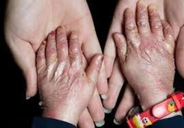 رنج تحریم بر بدن بیماران پروانهای رنج تحریم بر بدن بیماران پروانهای