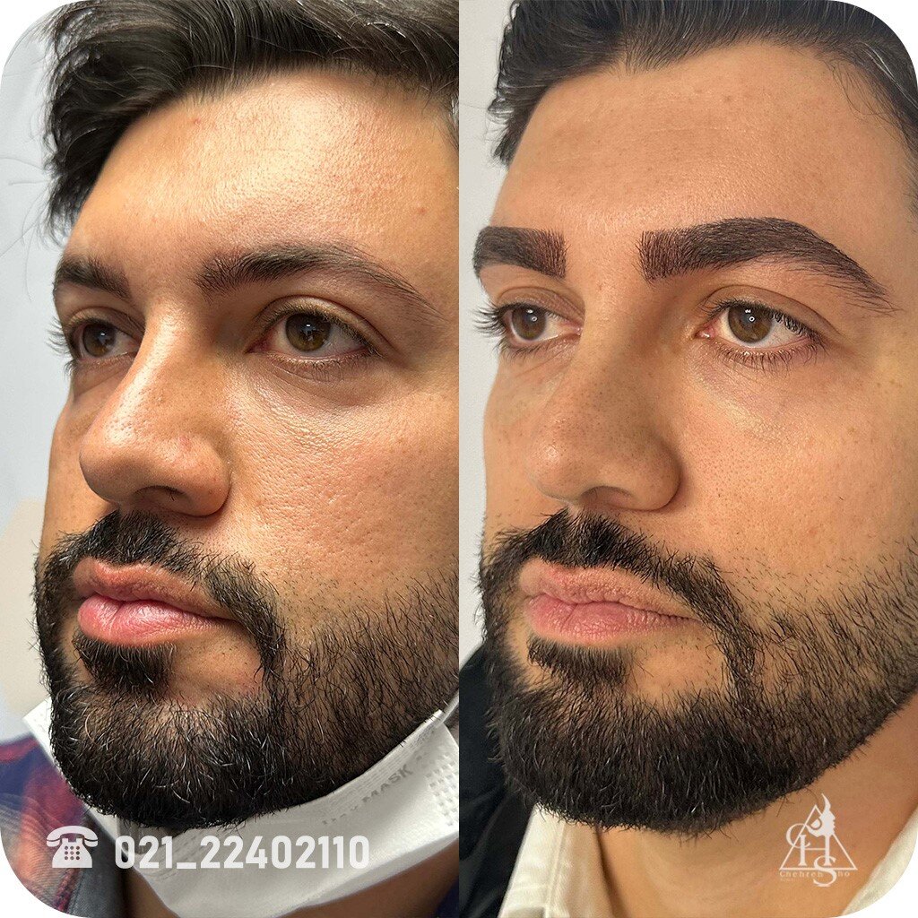 کاشت ابرو برای مردان