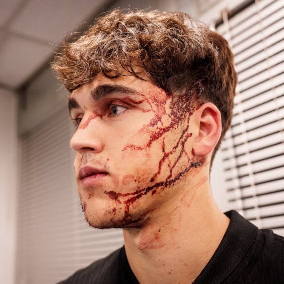 عکس | وضعیت ناراحتکننده پدیده بارسا با 10 بخیه!