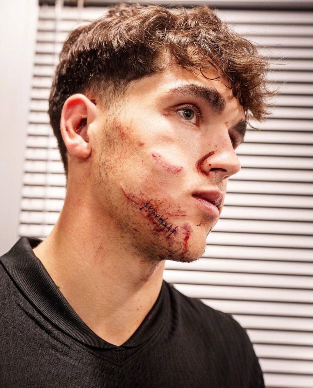 عکس | وضعیت ناراحتکننده پدیده بارسا با 10 بخیه!