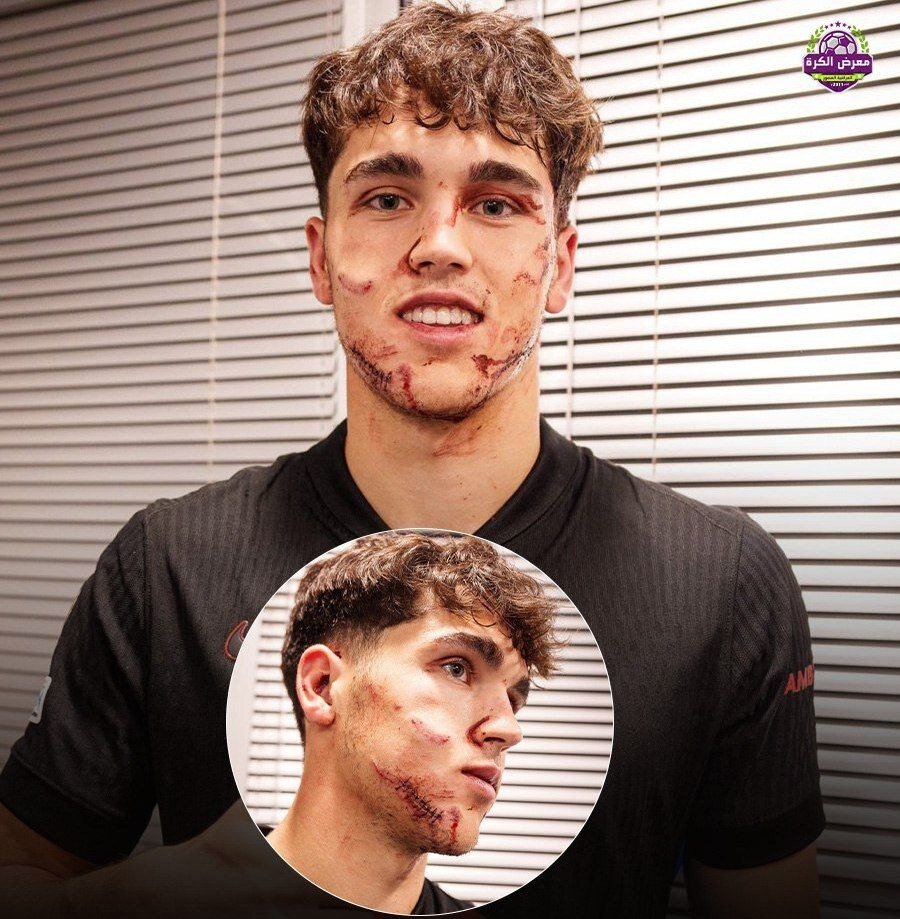 عکس | وضعیت ناراحتکننده پدیده بارسا با 10 بخیه!