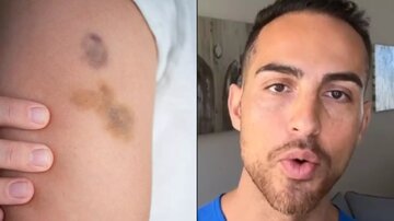 علت برخی کبودیهای بدون دلیل بدن چیست؟ علت برخی کبودیهای بدون دلیل بدن چیست؟