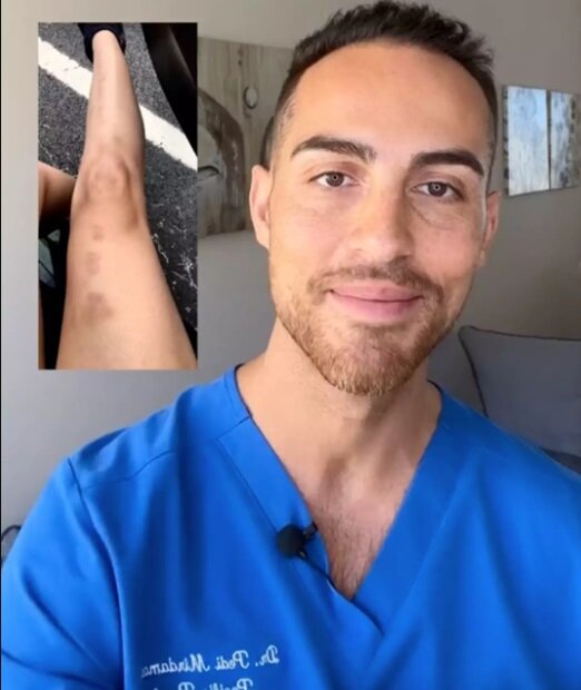 علت برخی کبودیهای بدون دلیل بدن چیست؟