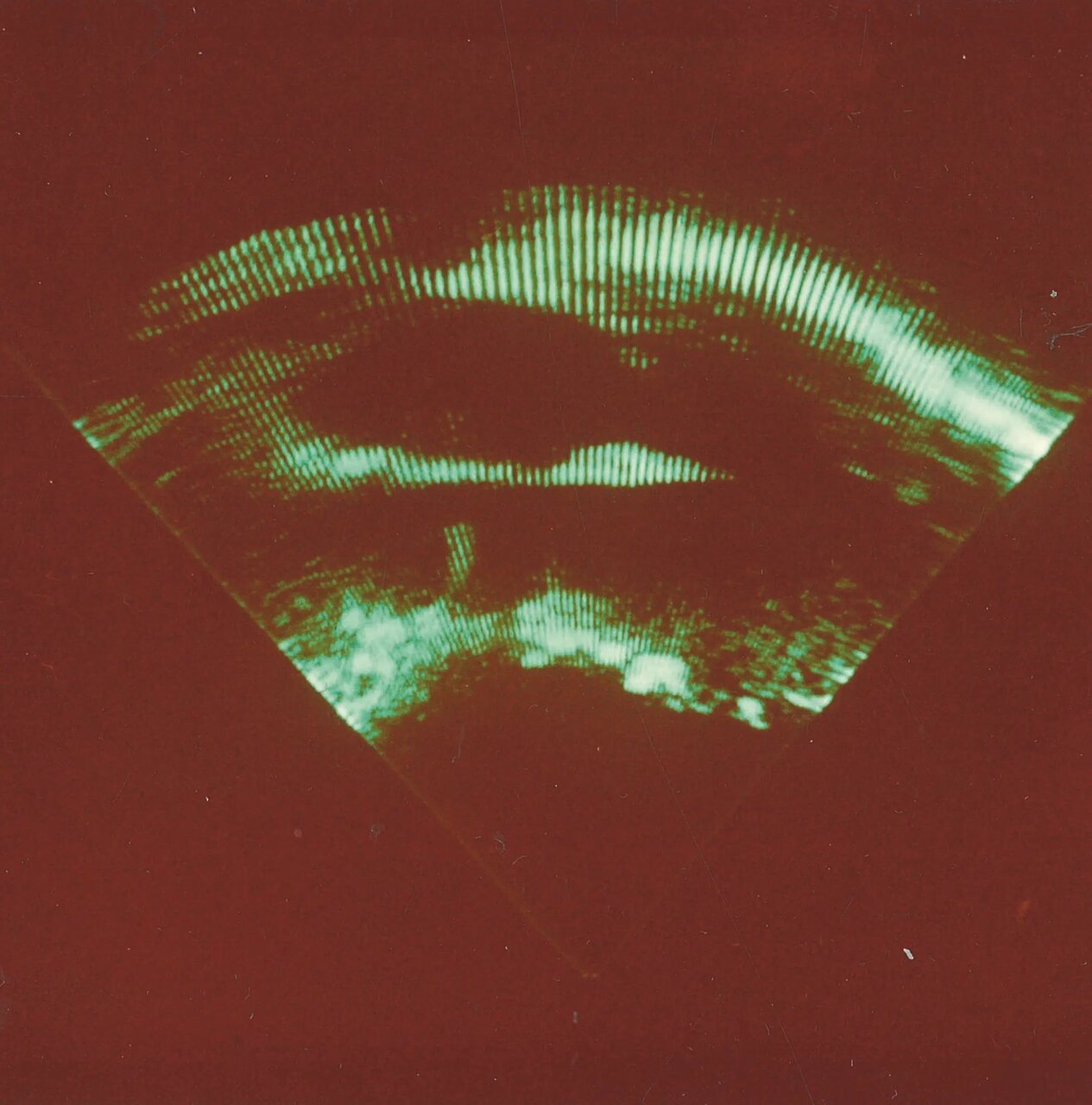 «سونوگرافی» چگونه کشف شد؟/ تصاویری از دستگاههای سونوگرافی در گذشت زمان