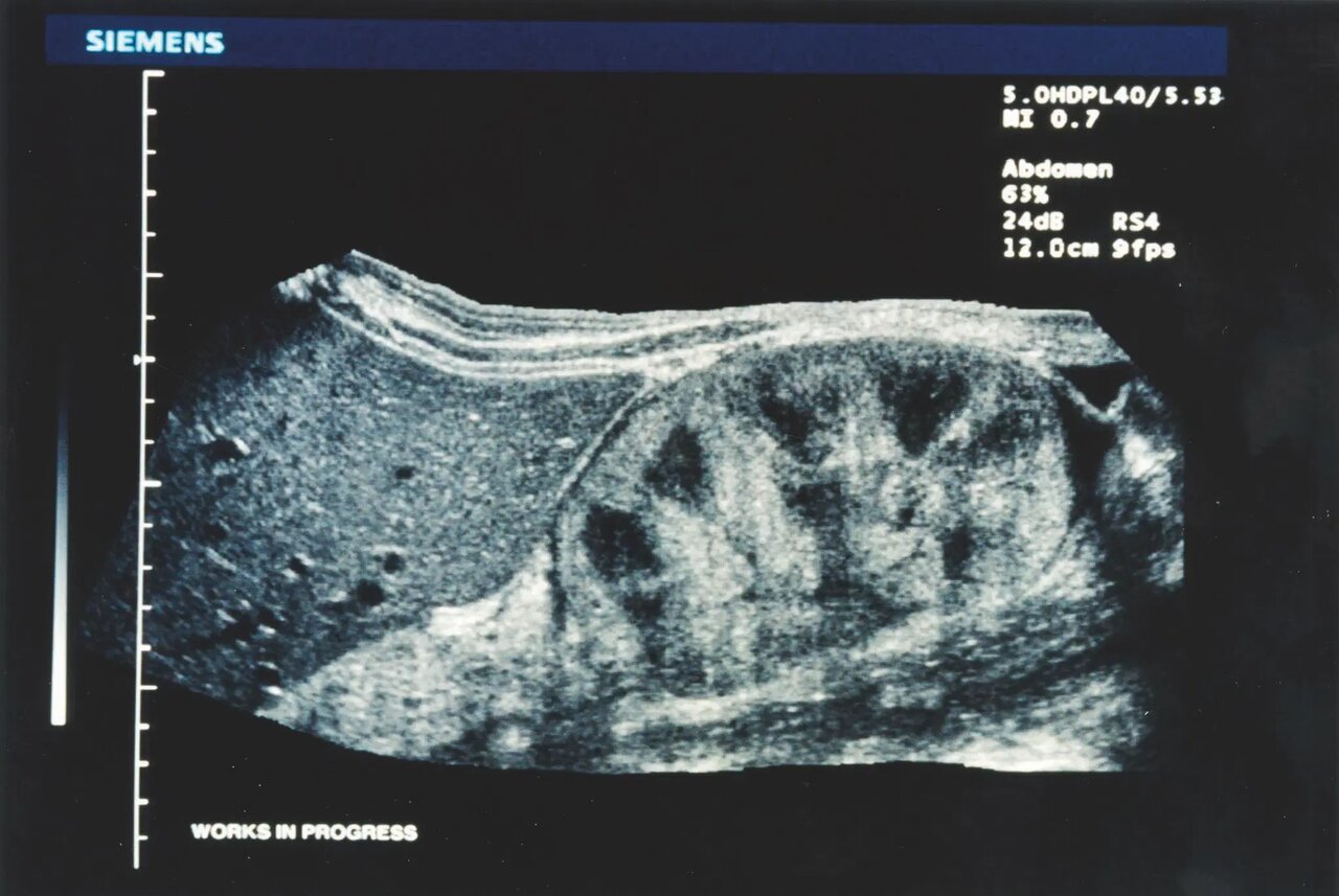 «سونوگرافی» چگونه کشف شد؟/ تصاویری از دستگاههای سونوگرافی در گذشت زمان
