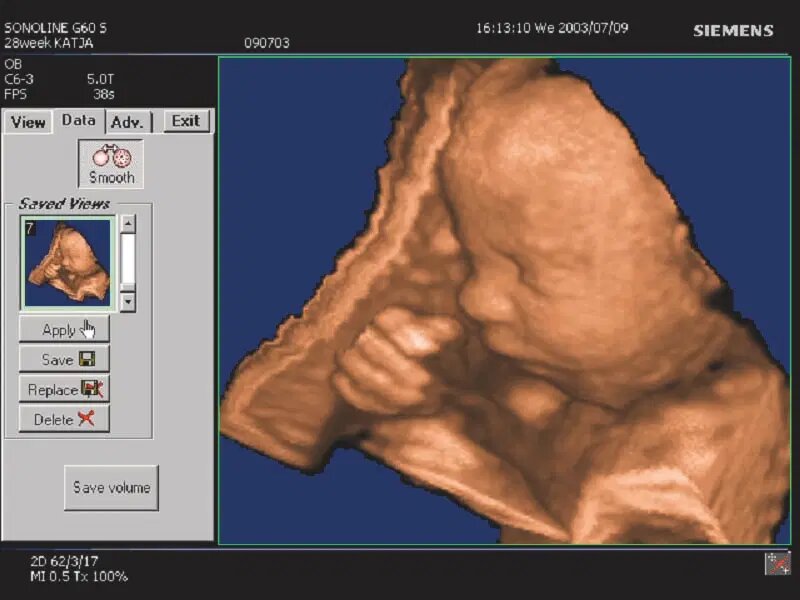 «سونوگرافی» چگونه کشف شد؟/ تصاویری از دستگاههای سونوگرافی در گذشت زمان