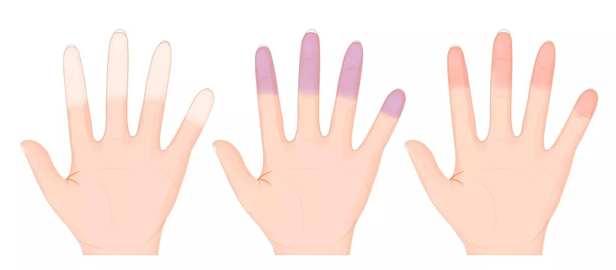 یخزدگی انگشتهای دست و پا ممکن است علت بیماری خطرناکی باشد؟