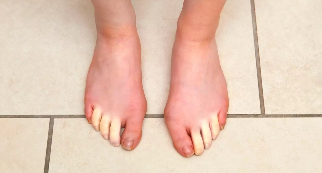 یخزدگی انگشتهای دست و پا ممکن است علت بیماری خطرناکی باشد؟