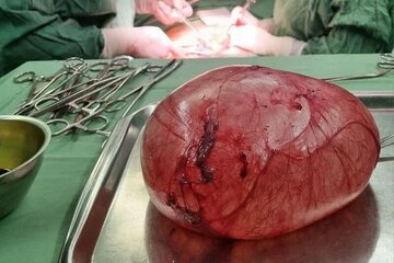 خروج توه ۱۵ کیلویی از شکم دختر ۱۳ ساله خروج توه ۱۵ کیلویی از شکم دختر ۱۳ ساله