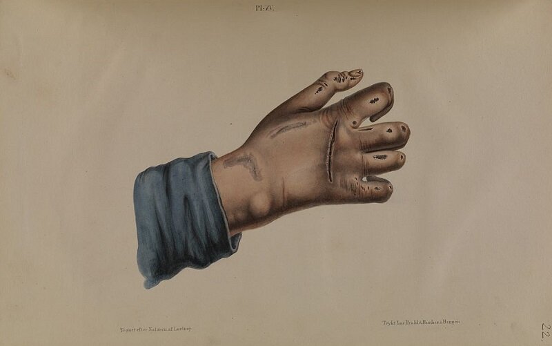 عفونتی به قدمت تاریخ؛ مبدأ جذام کجا بود؟/ موفقیت ایران در حذف این بیماری/ کدام استانها جذامخیز بودند؟