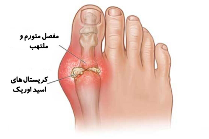 خوردن گوجه فرنگی باعث ابتلا به نقرس می‌شود؟/ ماده غذایی کم پورین یا محرک نقرس؟/ تحقیقات چه می‌گویند؟