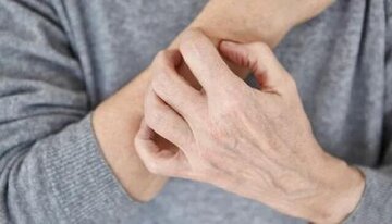 از خشکی پوست تا شبکوری و ناباروری؛ اثر کمبود این ویتامین بر بدن از خشکی پوست تا شبکوری و ناباروری؛ اثر کمبود این ویتامین بر بدن