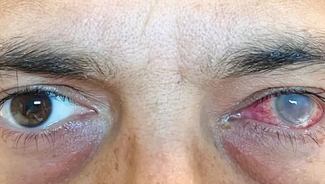 خواننده معروف چرا بیناییاش را از دست داد؟/ عفونتهای چشمی خطرناک را بشناسید