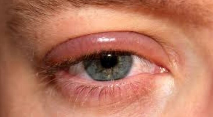 خواننده معروف چرا بیناییاش را از دست داد؟/ عفونتهای چشمی خطرناک را بشناسید