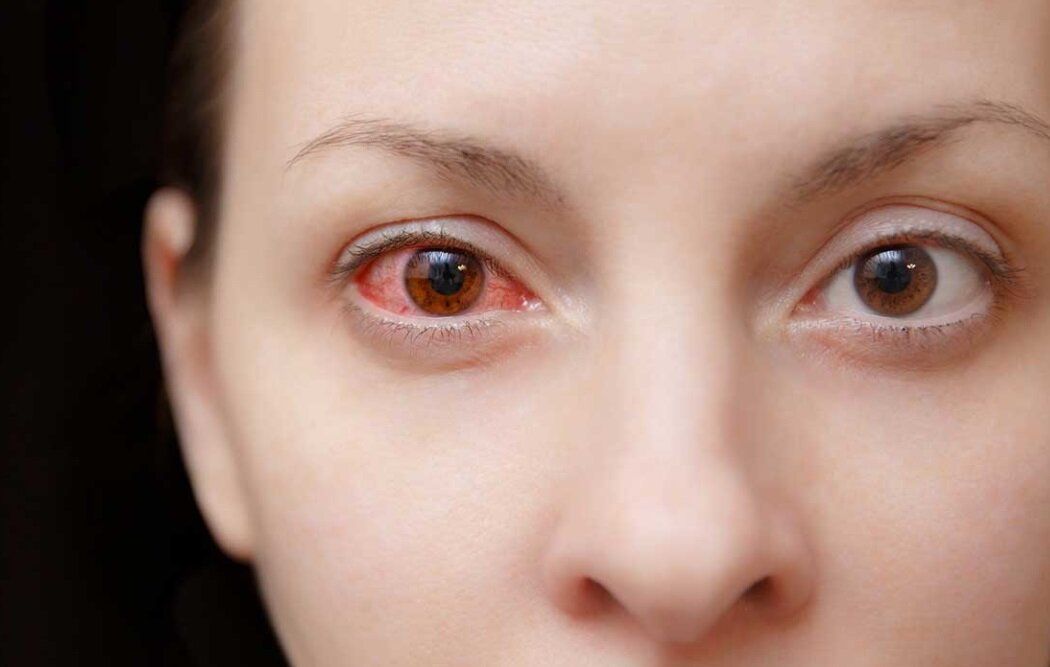 خواننده معروف چرا بیناییاش را از دست داد؟/ عفونتهای چشمی خطرناک را بشناسید