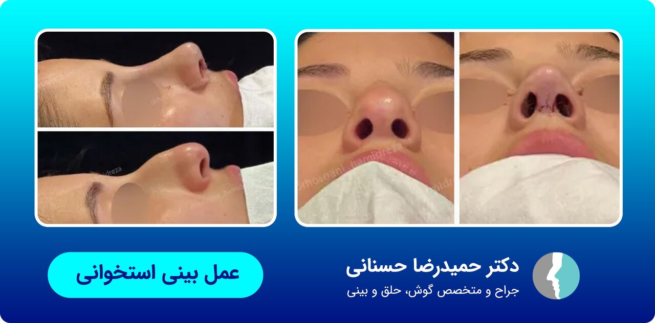 عمل زیبایی بینی با جراح متخصص
