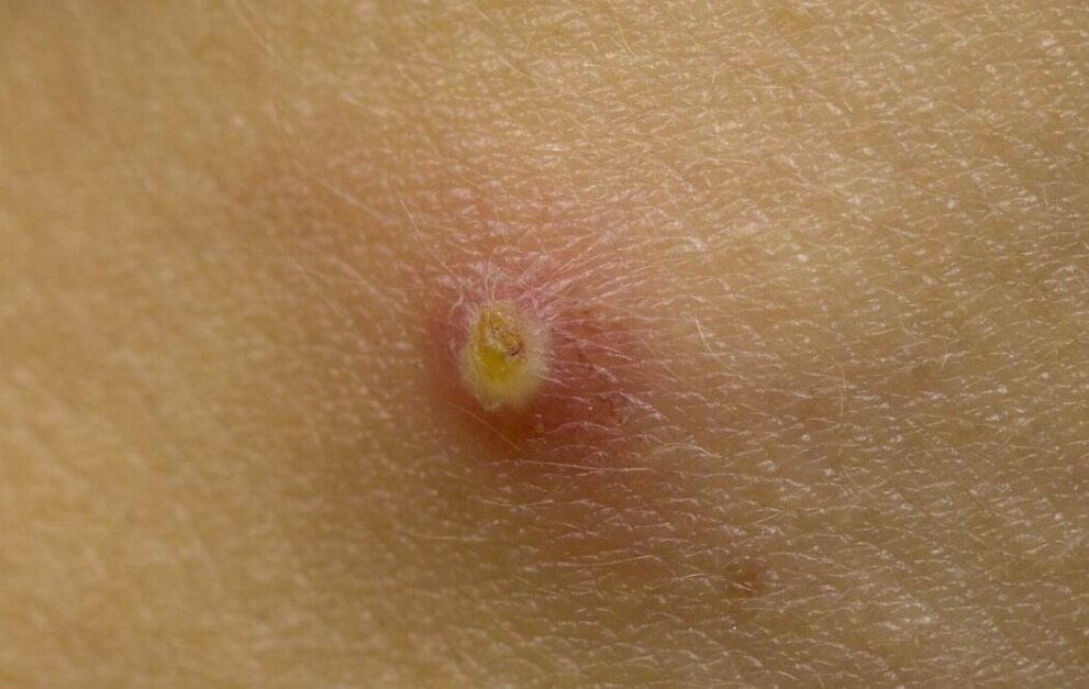 این مرد بهدلیل موهای زیرپوستی، ۹ بار جراحی شده/ پزشکان، درد ناشی از این بیماری را بدتر از «زایمان» توصیف کردهاند