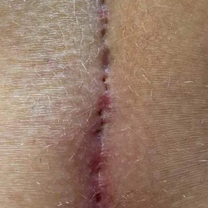 این مرد بهدلیل موهای زیرپوستی، ۹ بار جراحی شده/ پزشکان، درد ناشی از این بیماری را بدتر از «زایمان» توصیف کردهاند