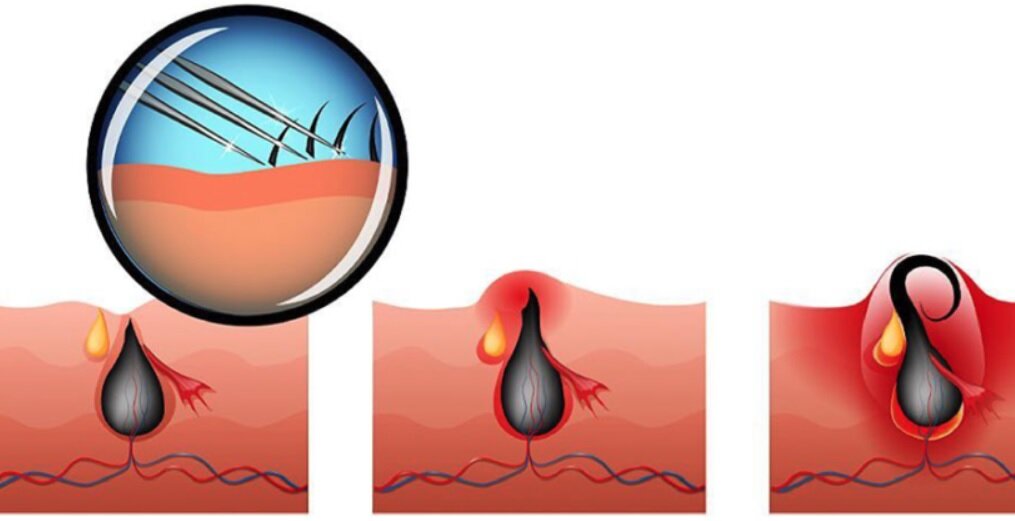 این مرد بهدلیل موهای زیرپوستی، ۹ بار جراحی شده/ پزشکان، درد ناشی از این بیماری را بدتر از «زایمان» توصیف کردهاند