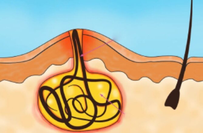 این مرد بهدلیل موهای زیرپوستی، ۹ بار جراحی شده/ پزشکان، درد ناشی از این بیماری را بدتر از «زایمان» توصیف کردهاند