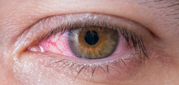 داروی محبوبی که سبب سکته چشمی میشود داروی محبوبی که سبب سکته چشمی میشود