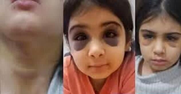 گزارش جدید از وضعیت آنیلا/ کودکآزاری هولناک در سنندج