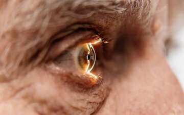 سکته چشمی چیست و چقدر خطرناک است؟ سکته چشمی چیست و چقدر خطرناک است؟