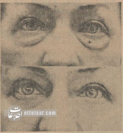 اولین جراحیهای زیبایی در تهران در کدام بیمارستان انجام شد؟/ عکس