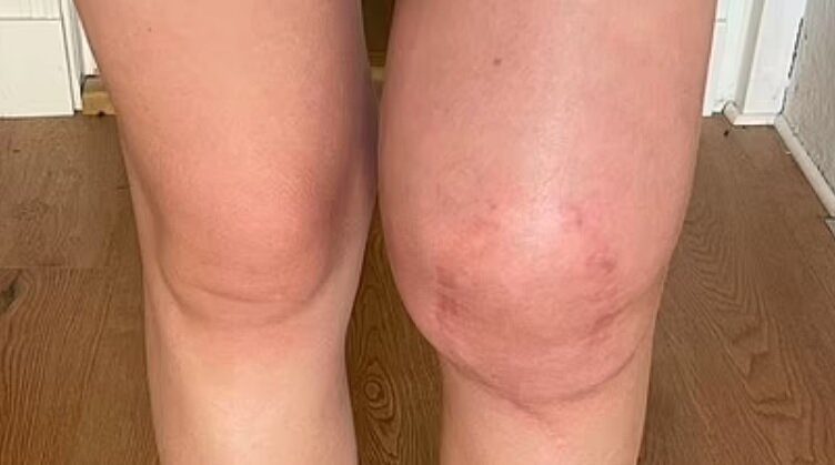 علایم یکی از سرطانهای مرگبار کودکان