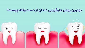 بهترین روش جایگزینی دندان از دست رفته چیست؟