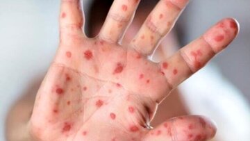 زنگ خطر شیوع بیماری کشنده در یزد/ آمار موارد ابتلا؛ بیماران ایرانی هستند یا اتباع؟ زنگ خطر شیوع بیماری کشنده در یزد/ آمار موارد ابتلا؛ بیماران ایرانی هستند یا اتباع؟