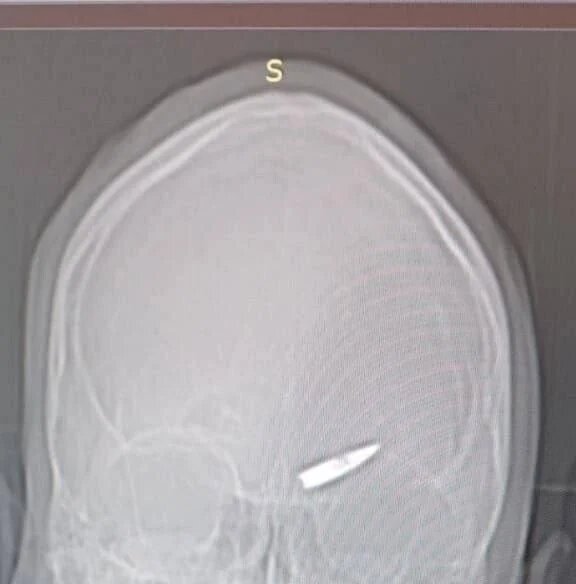 این سرباز با گلولهی در مغز یک هفته جنگید!/عکس