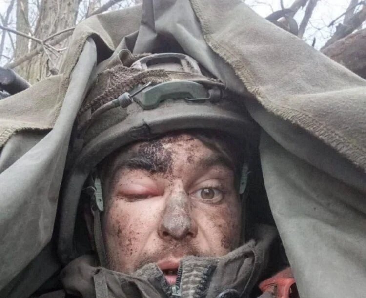 این سرباز با گلولهی در مغز یک هفته جنگید!/عکس